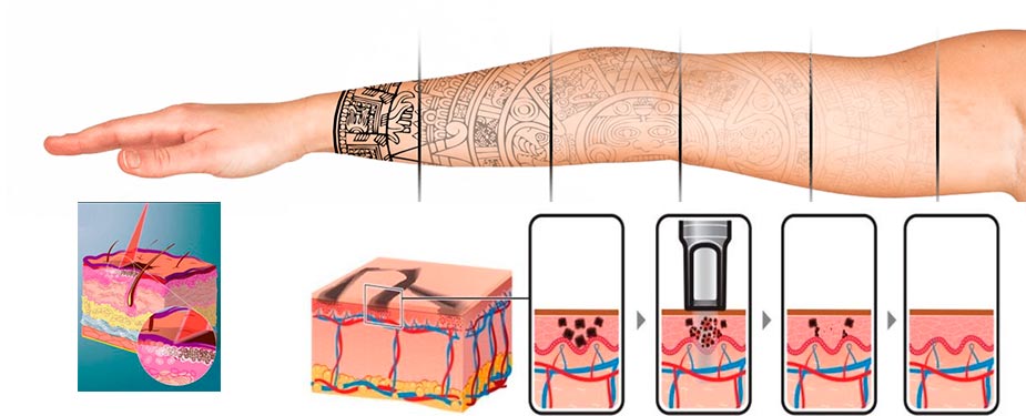 grafico explicativo sobre borrar tatuajes