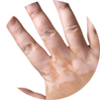 thmb-vitiligo
